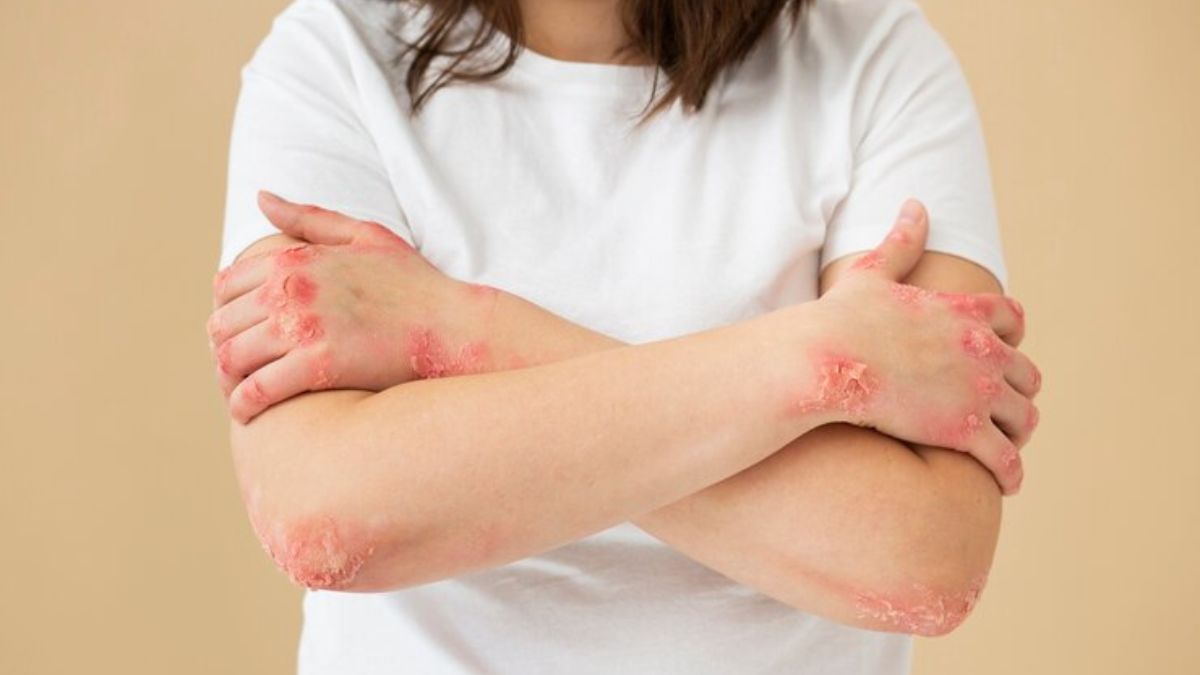 Atopic Dermatitis