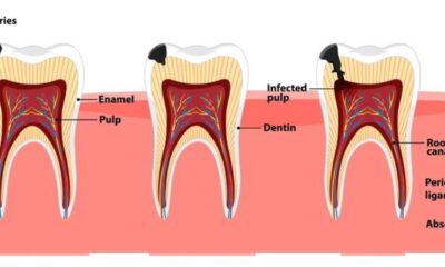 Root Canal