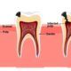 Root Canal