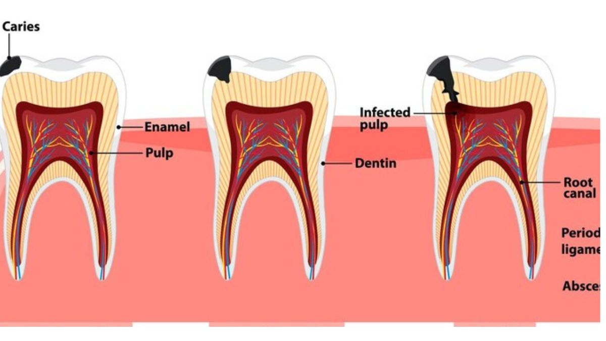 Root Canal