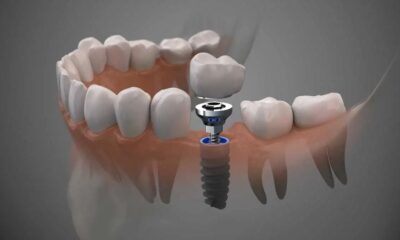 Dental Implants