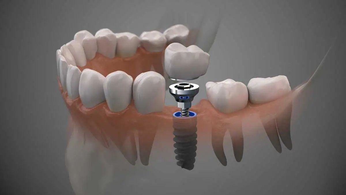 Dental Implants