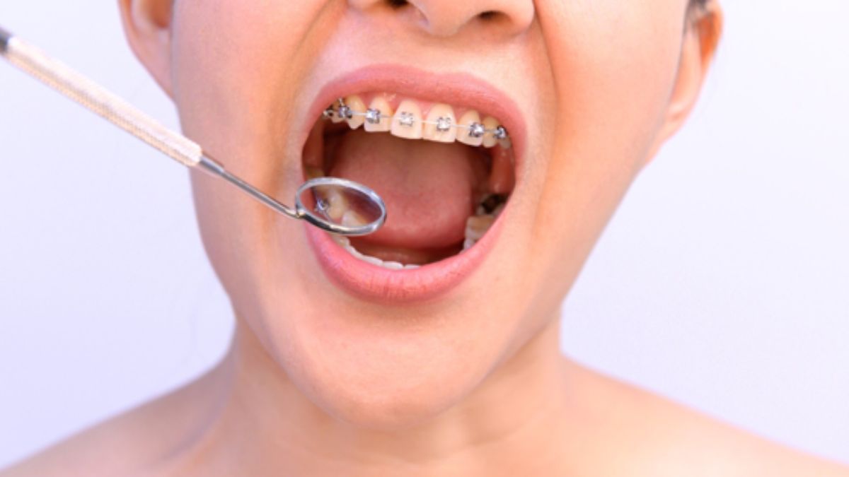 Dental Braces