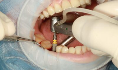 Dental Implant