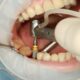 Dental Implant