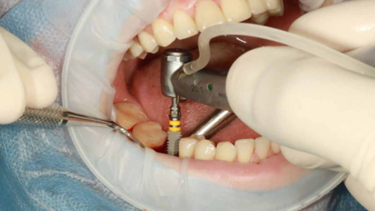 Dental Implant