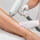 Laser Hair Removal